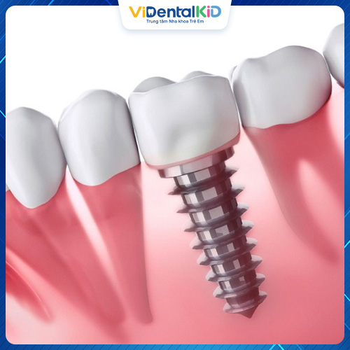Cấy ghép Implant là hình thức trồng răng giả cố định