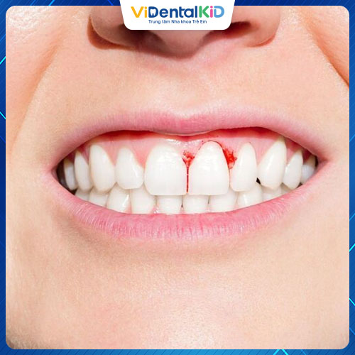 Viêm lợi có thể khiến răng bị rụng