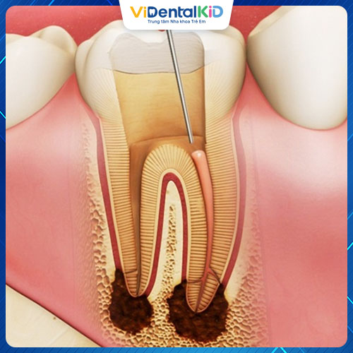 Viêm tủy răng có thể gây biến chứng nếu không được xử lý