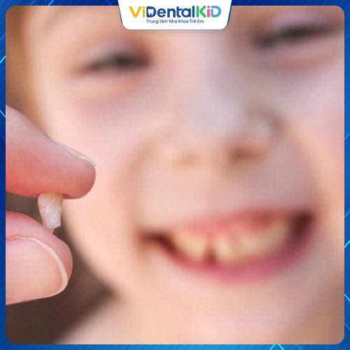 Sâu răng có thể khiến trẻ bị mất răng