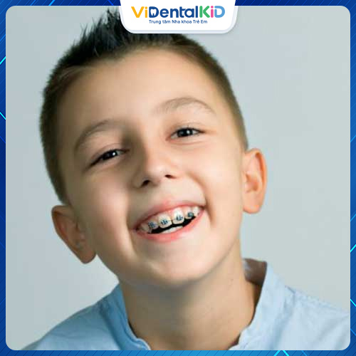 Độ tuổi niềng răng cho trẻ tốt nhất từ 12 – 16 tuổi