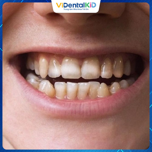 Men răng bị axit từ thức ăn hoặc đồ uống bào mòn
