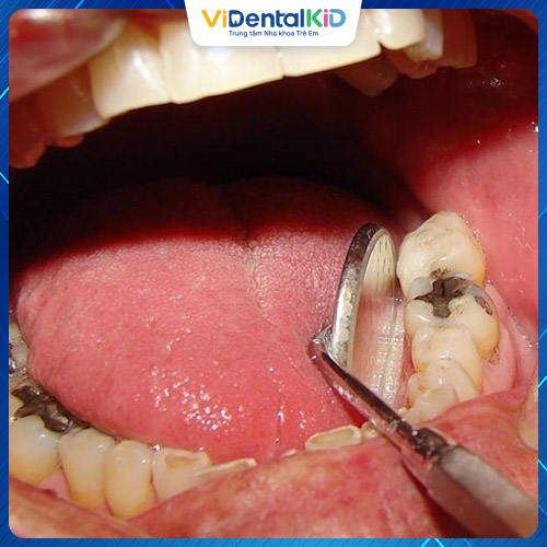 Sâu răng là bệnh lý dễ mắc phải ở bất kỳ độ tuổi nào