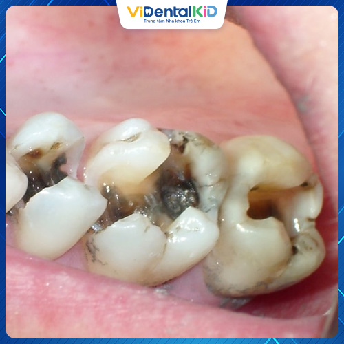 Hoại tử, mất răng là biến chứng nặng nề nhất do bệnh gây ra