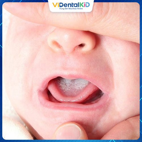 Dấu hiệu nhận biết nấm miệng ở trẻ