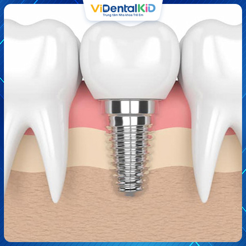Trồng răng implant mất bao lâu là thắc mắc của không ít người