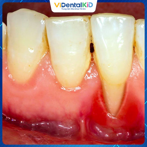 Tụt lợi chân răng hàm dưới thường khó phát hiện hơn so với hàm trên