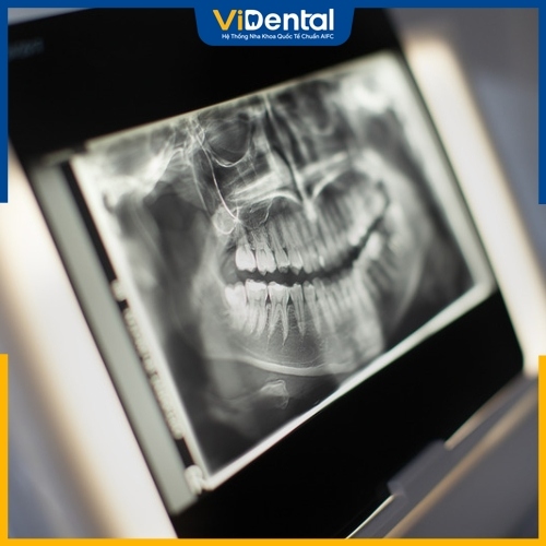 Chụp X-quang giúp mô phỏng hình ảnh khoang miệng chính xác nhất 