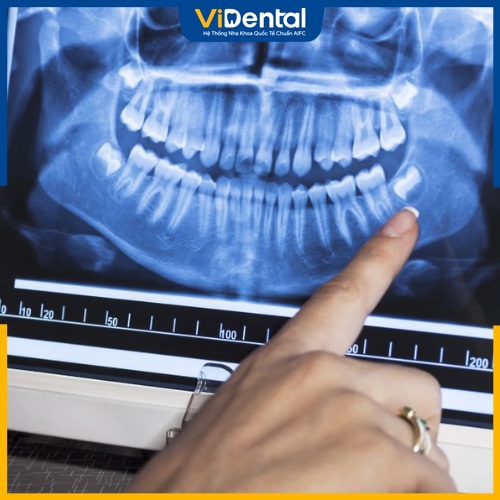 Chụp X-quang răng khôn bao nhiêu tiền là câu hỏi của nhiều khách hàng