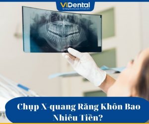 Chụp X-quang răng khôn bao nhiêu tiền