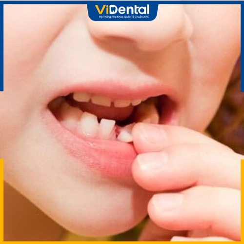 Trẻ bị chấn thương răng gây đau nhức 