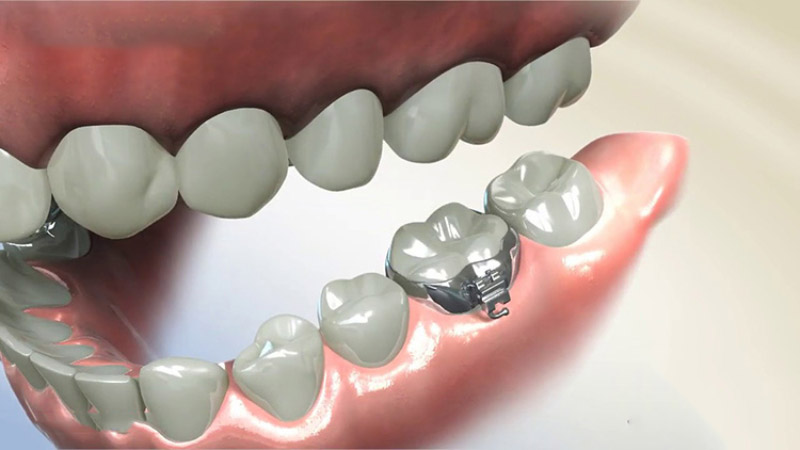 Gắn khâu niềng răng sẽ phù hợp nhất đối với trường hợp khớp cắn sâu, thân răng ngắn