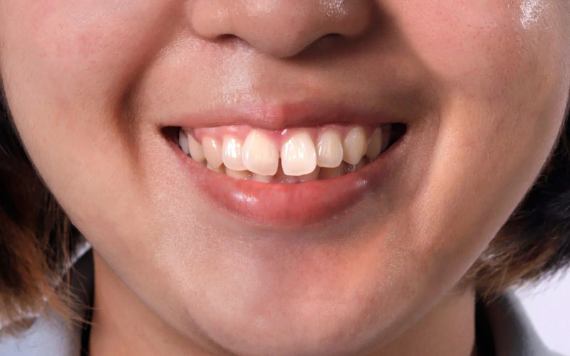 Trường hợp răng thưa, khấp khểnh nên sử dụng niềng trong suốt