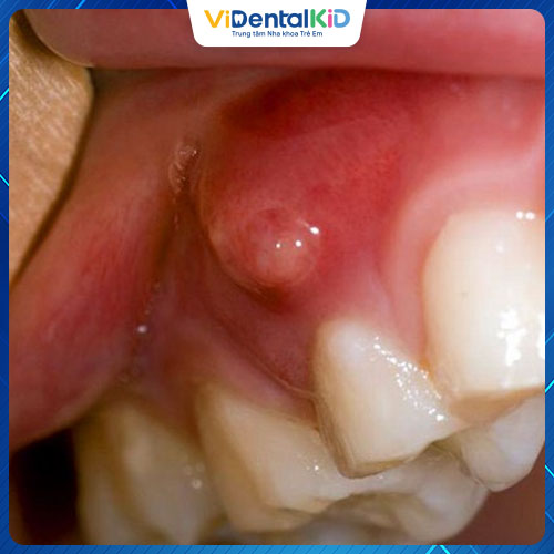 Áp xe răng gây ra nhiều ảnh hưởng đến sức khỏe răng miệng
