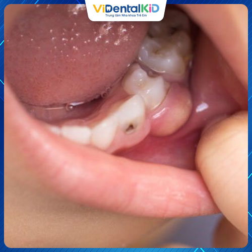 Áp xe răng ở trẻ em có thể xử lý tại nhà