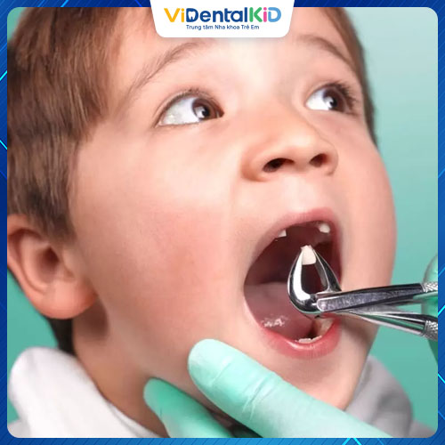 Cần nhổ răng nếu răng của trẻ bị hư hỏng hoàn toàn