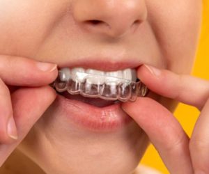 Niềng răng cho trẻ em có chi phí thấp hơn người lớn