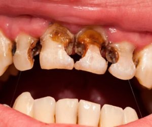 Nếu mắc bệnh răng miệng cần trả thêm phí điều trị
