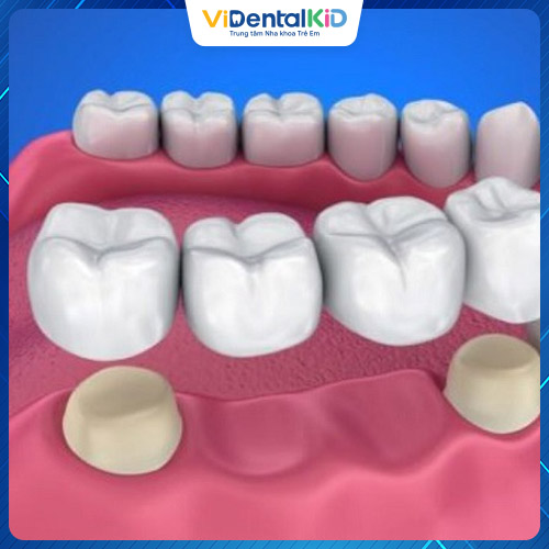 Cầu răng sứ là phương pháp trồng răng giả cố định