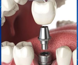 Trồng răng Implant hay còn được biết đến với cái tên là cấy ghép Implant