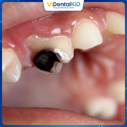 Viêm tủy răng có thể gây nên các biến chứng nguy hiểm