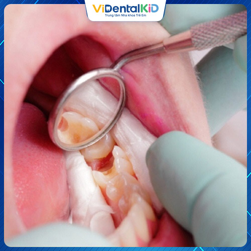 Để chấm dứt tình trạng viêm tủy răng kéo dài, bạn cần đến gặp bác sĩ điều trị