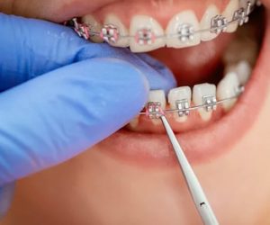 Kỹ thuật niềng răng ảnh hưởng đến giá niềng răng