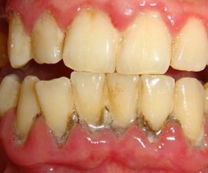 Nếu gặp vấn đề răng miệng khách hàng phải trả thêm phí điều trị
