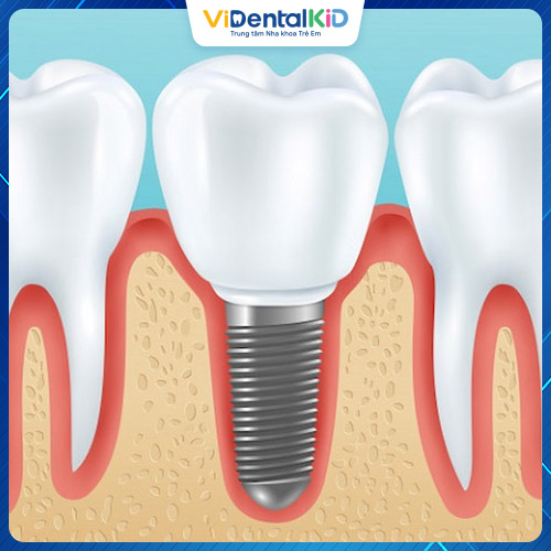 Phục hình răng Implant là phương pháp hiện đại nhất hiện nay
