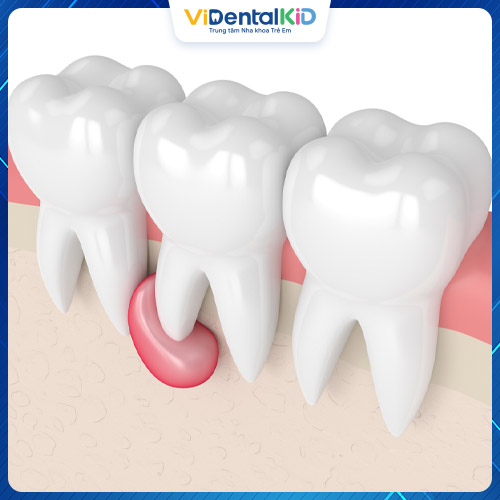 Nang răng có thể gây ra nhiều biến chứng nguy hiểm