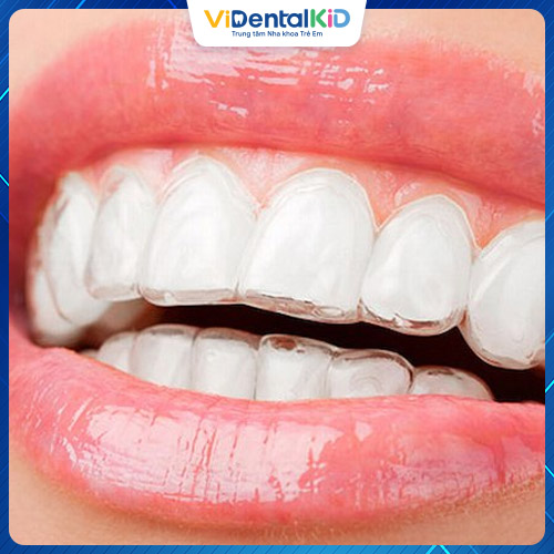 Niềng răng Invisalign là một trong các phương pháp niềng răng phổ biến