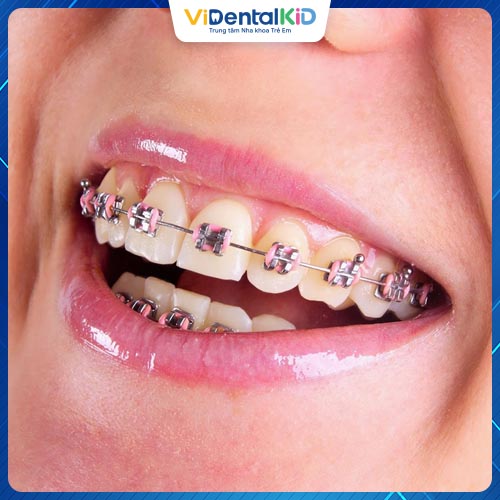 Phương pháp này có thể khắc phục tình trạng răng khấp khểnh
