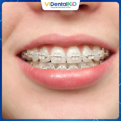 Phương pháp này giúp khắc phục các khuyết điểm về răng, mang lại hàm răng đều đẹp