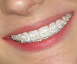 Kỹ thuật niềng răng ảnh hưởng đến giá dịch vụ