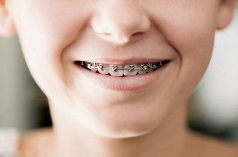 Từ 7 - 10 tuổi là độ tuổi đẹp nhất để thực hiện niềng răng