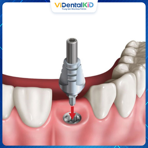 Trồng răng giả được lựa chọn khi nhổ bỏ hoàn toàn răng cửa bị sâu