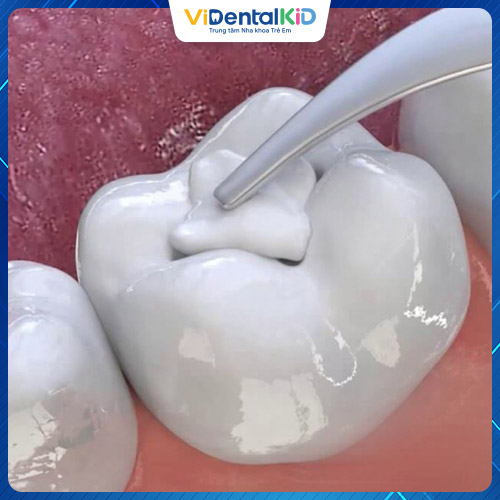 Trám răng xử lý sâu răng nhẹ an toàn, hiệu quả cao