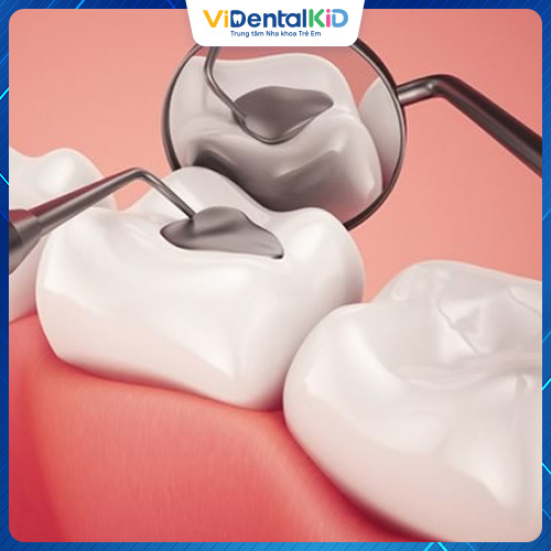 Trám răng là phương pháp sử dụng vật liệu trám để phục hồi chức năng của răng