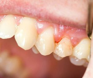 Tình trạng răng miệng tác động đến chi phí niềng răng